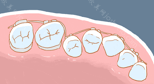牙齿矫正中颊廊是哪个部位呢？颊廊在牙齿矫正中的作用