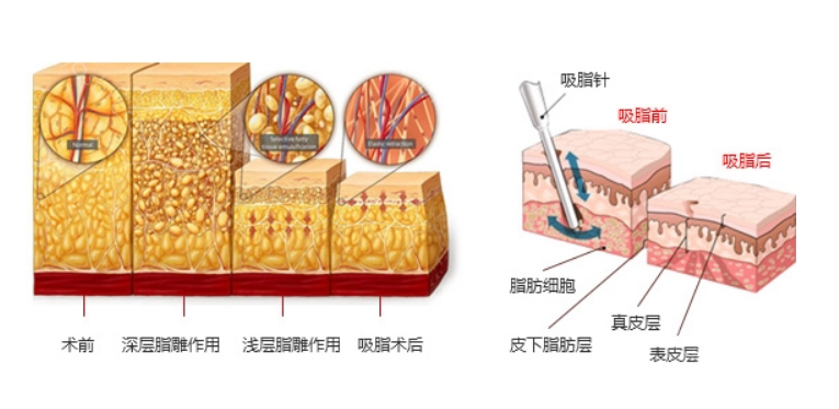 成都画美整形吸脂怎么样?赵敬国吸脂技术可靠