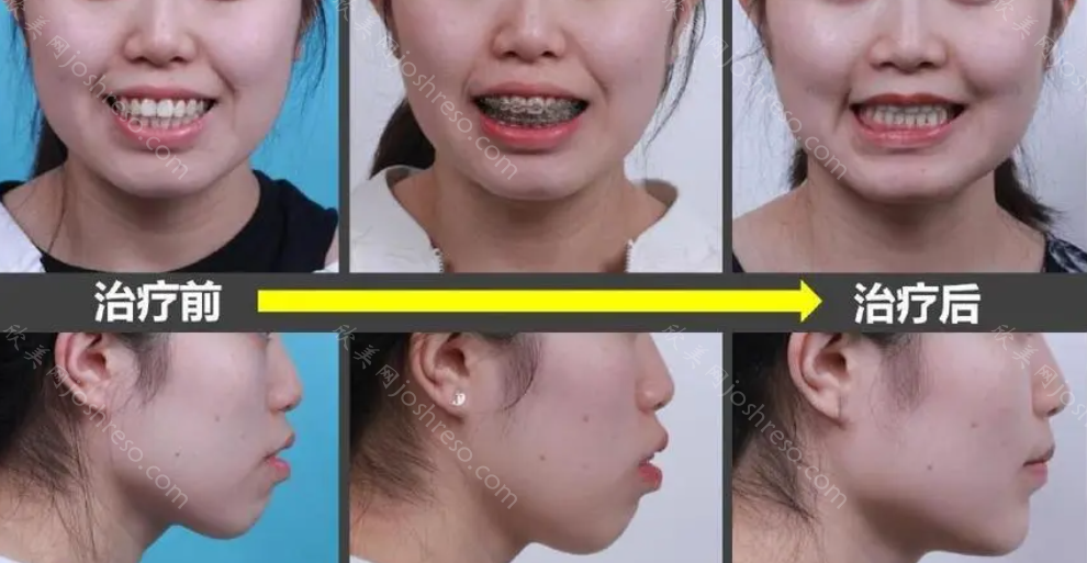 凸嘴做正颌手术价格一般是多少？做正颌手术后脸型会发生什么变化？