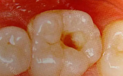 牙髓息肉怎么治疗？有牙髓息肉的坏牙能直接拔掉