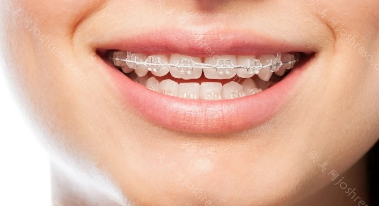 牙齿矫正是个坑!高昂的费用,不适和疼痛,矫正后的维护