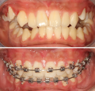 牙齿深覆合矫正前后的脸型变化,牙齿深覆合矫正的优势