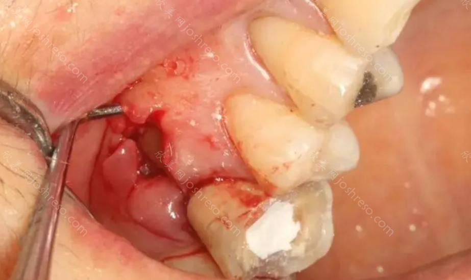 牙髓炎早期症状，如何预防牙髓炎