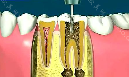 牙髓炎早期症状，如何预防牙髓炎
