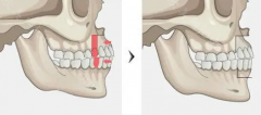 牙槽骨吸收过多，会导致牙齿松动、脱落！如何判断牙槽骨有没有吸收？