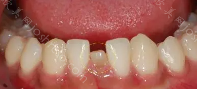 乳牙为什么尽量不要根管治疗？乳牙根管治疗的风险
