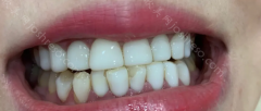 牙齿贴面可能会影响牙齿的健康！牙齿贴面不适用于所有人