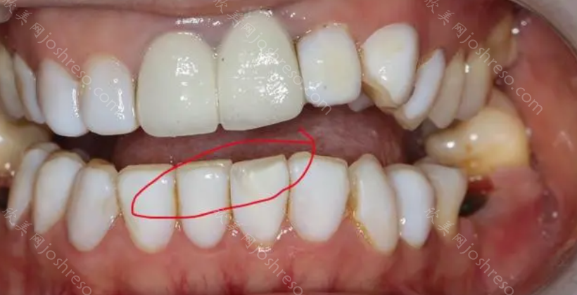 牙齿贴面可能会影响牙齿的健康！牙齿贴面不适用于所有人