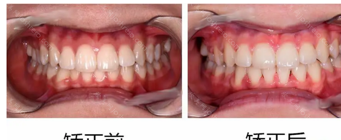 成都牙齿矫正医院如何选择？看案例，你就明白了！