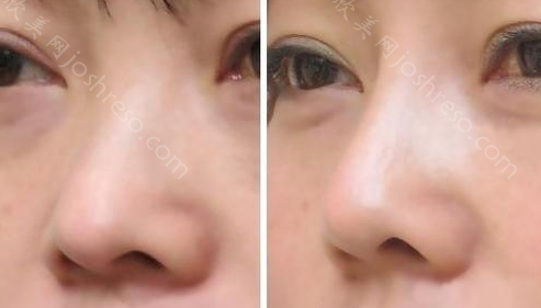 垫鼻子后出现鼻头硬，该如何治疗？