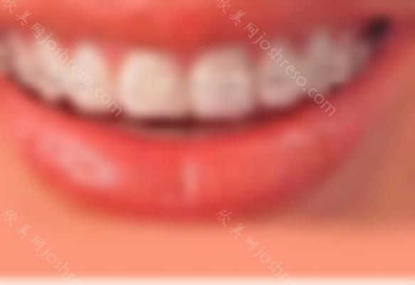 成都的牙齿矫正种类有哪些？矫正牙齿有哪些问题？