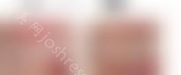 成都牙齿矫正李文星博士技术怎么样？案例对比图一看就知晓！