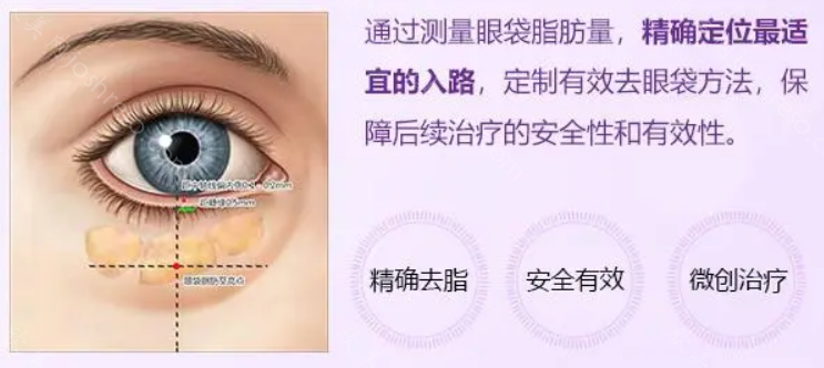 眼袋/眼周/黑眼圈去除价格表(收费标准)公开,2023年眼袋去除价格为8000-30000元之