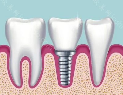 长沙美奥口腔医院价格表?种植牙齿技术做的好不好在线看!