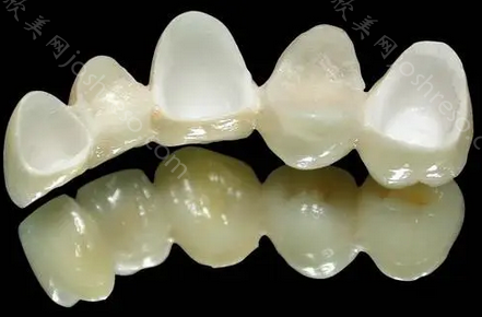 门牙尽量不做全瓷牙吗?门牙全瓷牙失败原因医生告诉你正确答案!