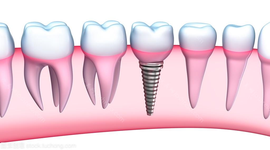 种植牙有没有什么副作用和危害？牙齿缺失怎么选择合适的修复方式