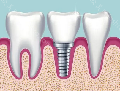 韩国进口种植牙的价格?韩国进口种植牙价格影响因素大盘点!