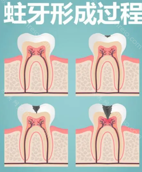 大牙烂到什么程度必须拔?蛀牙有洞是拔掉好还是补牙好?