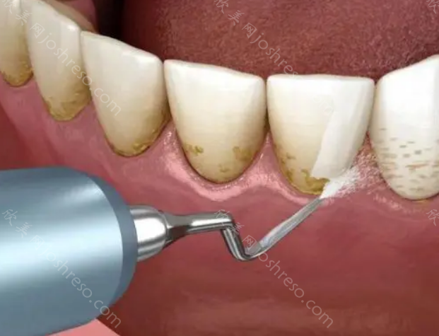 牙科医院收费价格表2023揭晓：包含洗牙价目表哟!