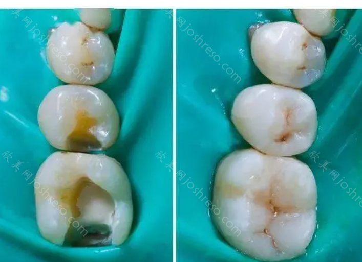 儿童医院牙科收费标准：看完你就知道孩子看牙需要多少钱啦