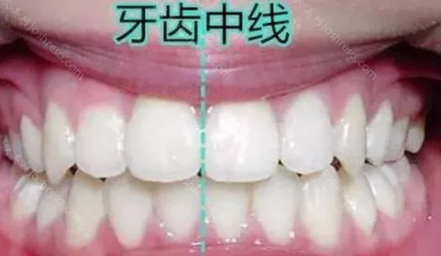 正常牙齿咬合标准图是怎么样的?对照看看你的牙齿是否排列整齐?