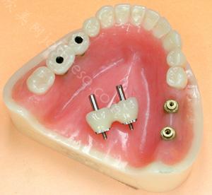 昆明雅度口腔医院收费标准上新了：植牙的数量、材料等都会影响收费！