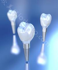 2023上海牙博士口腔种植牙价格表已更新，瑞士ITI种植牙10200-22800元左右