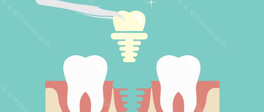 中诺口腔医院种植牙多少钱(价格表)？美国百康种植牙16000元起/颗	
