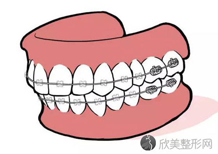 矫正牙齿哪个阶段比较痛苦？了解矫正几大步骤就明白了