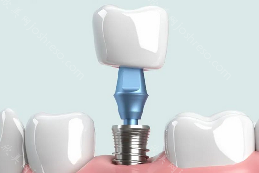 2023种牙多少钱一颗呢?种牙费用影响因素解析!