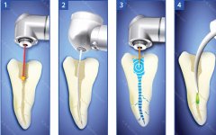 虫牙根管治疗和补牙的区别?这些你需要了解