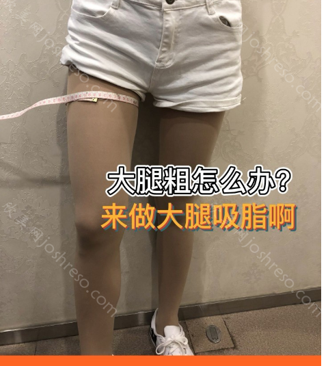 贵阳华美李如杰吸脂怎么样?技术娴熟，医生真实介绍+吸脂案例分享