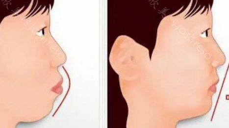 凸嘴和正常嘴型区别图?凸嘴的改善方法也介绍给你