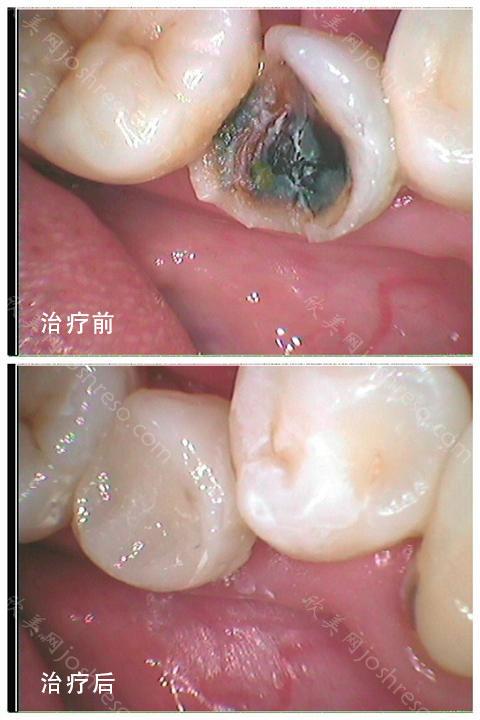 蛀牙如何让它停止腐蚀