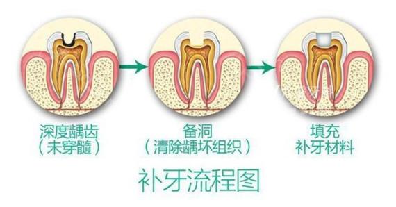 蛀牙黑的地方如何变白