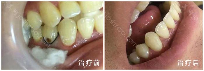 重度四环素牙如何美白