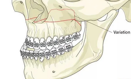 正颌手术毁我一辈子?来看正颌手术是否有风险