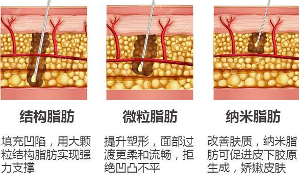 吸脂减肥瘦身价格多少?吸脂减肥费用成因解析,吸脂相关科普