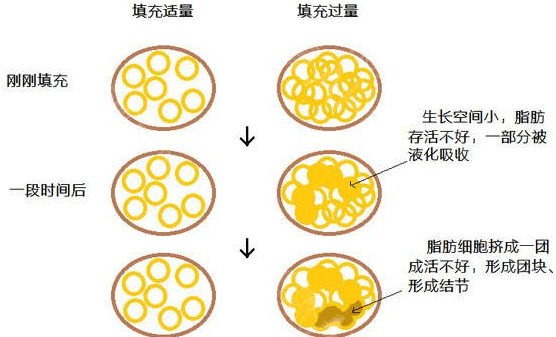 吸脂减肥瘦身价格多少?吸脂减肥费用成因解析,吸脂相关科普