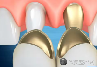 牙桩哪个好?纤维牙柱和金属牙柱两者之间的区别
