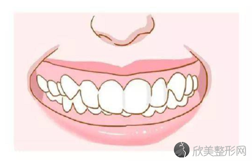牙齿深覆合平导在哪个步骤？牙齿深覆合对咬合功能的影响大家要知道