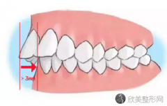 牙齿深覆合平导在哪个步骤？牙齿深覆合对咬合功能的影响大家