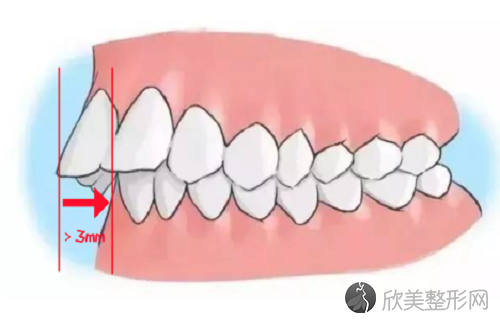 牙齿深覆合平导在哪个步骤？牙齿深覆合对咬合功能的影响大家要知道
