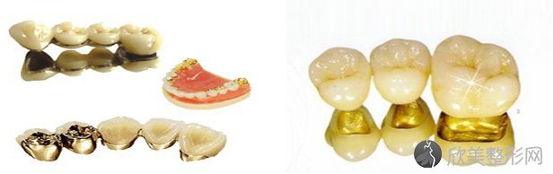 各种牙冠价格表及图片_牙冠种类_护理知识