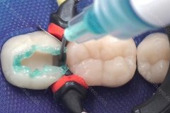 活动义齿隐形的好还是钢托的好?戴活动义齿需要注意什么？