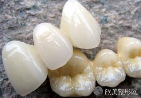 全瓷牙套哪个好?全瓷牙品牌十大哪家好!这几个全瓷牙品牌质量好!