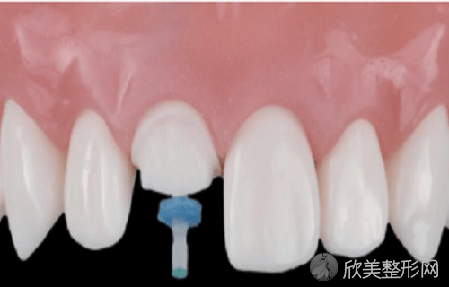 牙科纤维桩哪个好？附打纤维桩修复的步骤流程