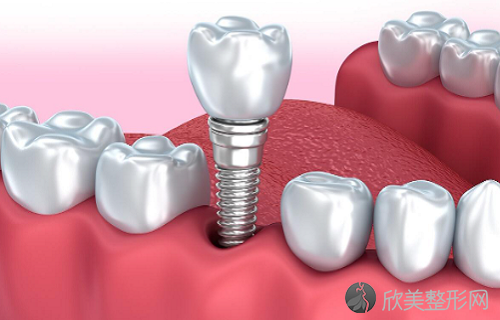 种植牙诺贝尔和博德哪个好？种植牙保养好寿命才长