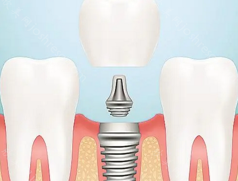番禺种植牙多少钱一颗?番禺区种牙好医院排名
