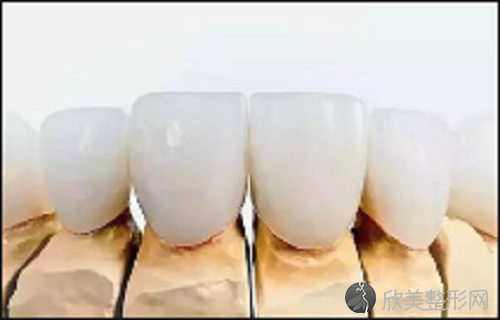 emax全瓷牙是哪个国家的？全瓷牙的耐久性较好